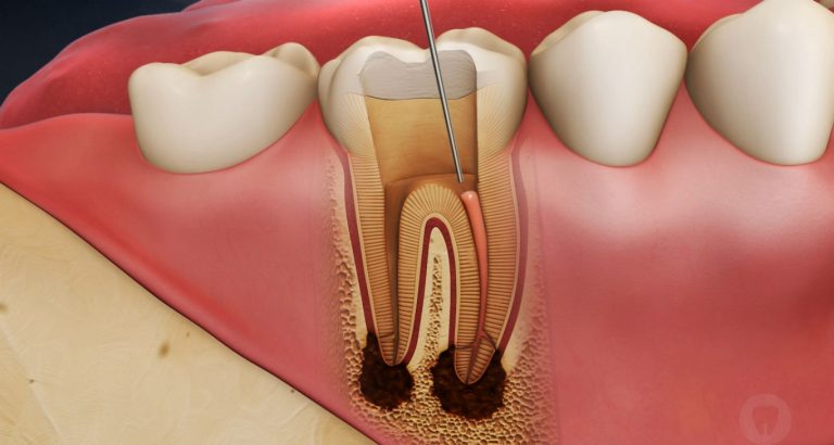 علل بروز درد دندان پس از درمان ریشه (عصب کشی)