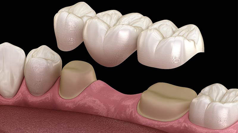 انواع روش های جایگزینی دندان های از دست رفته